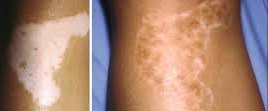vitiligo pigmentação e cura