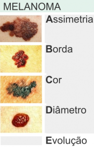 Melanoma