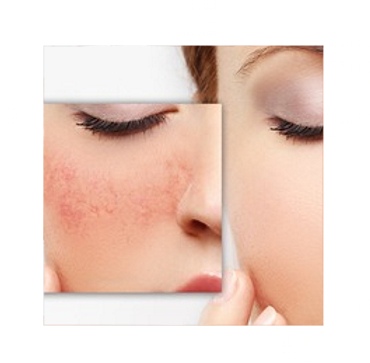 Rosacea