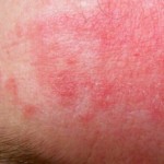 Eczema