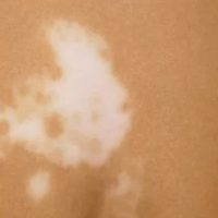 Vitiligo e Psoríase