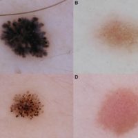 Dermatoscopia - Pintas e verrugas