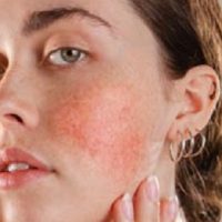 Rosácea facial